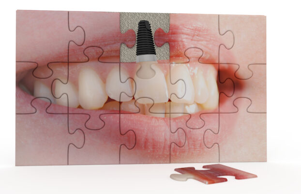Quais os benefícios do implante dentário?