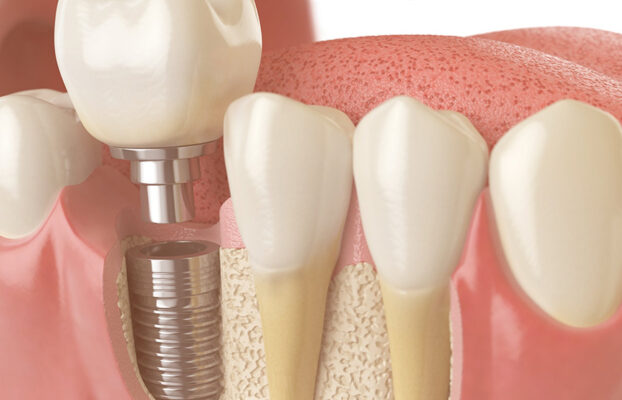 O Que São Implantes Dentários?
