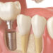 tipos de implantes dentarios 1