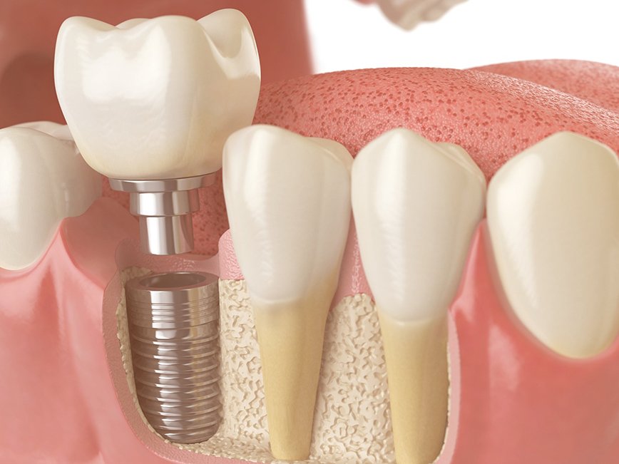 O Que São Implantes Dentários?